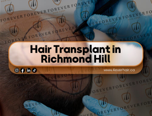 hair transplant in Richmond Hill