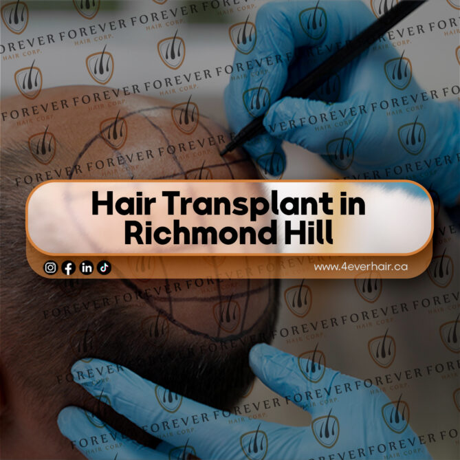 hair transplant in Richmond Hill