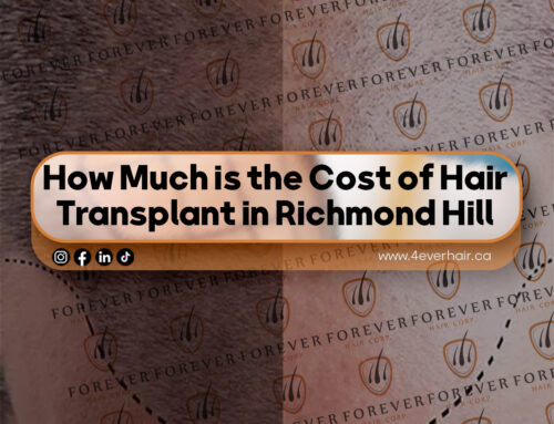 How Much is the Cost of Hair Transplant in Richmond Hill