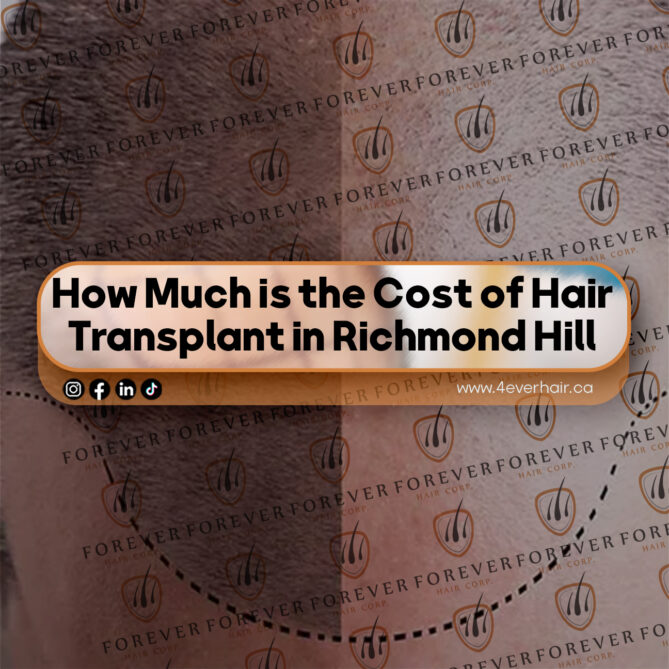 How Much is the Cost of Hair Transplant in Richmond Hill