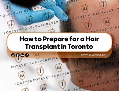 How to Prepare for a Hair Transplant in Toronto