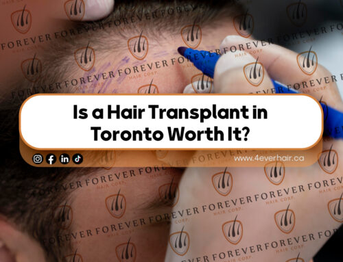 Is a Hair Transplant in Toronto Worth It?