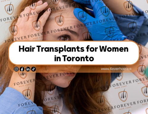 Hair Transplants for Women in Toronto